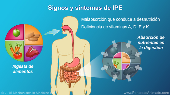 Insuficiencia pancreática exocrina (IPE) - Slide Show - 7