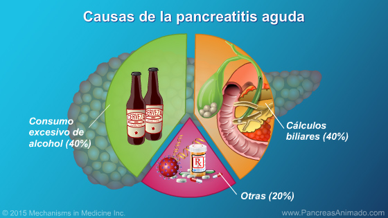 Pancreatitis aguda - Slide Show - 6