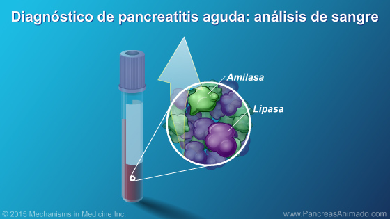 Pancreatitis aguda - Slide Show - 9