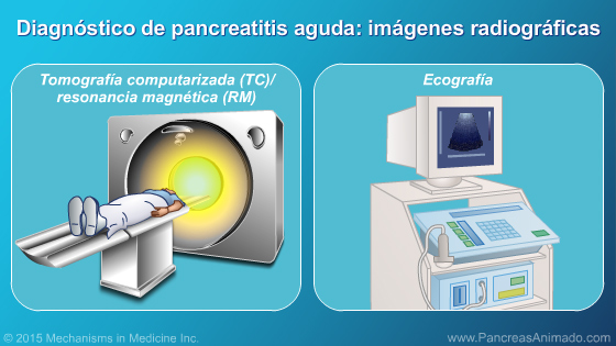 Pancreatitis aguda - Slide Show - 10