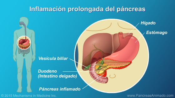 Pancreatitis crónica - Slide Show - 3