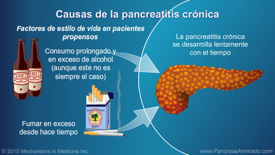 Pancreatitis crónica - Slide Show - 5