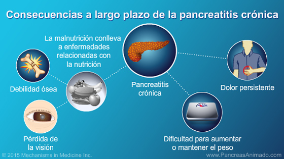 Pancreatitis crónica - Slide Show - 9