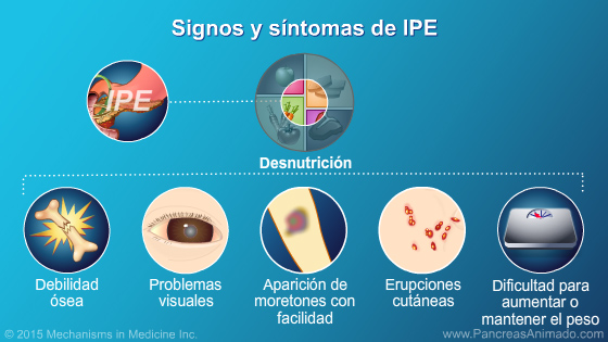 Insuficiencia pancreática exocrina (IPE) - Slide Show - 8