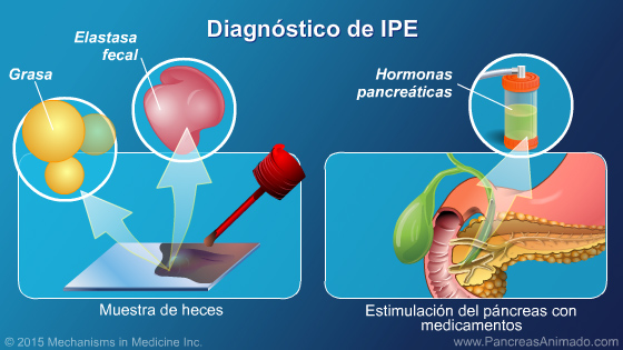 Insuficiencia pancreática exocrina (IPE) - Slide Show - 11