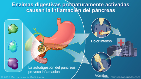Manejo y tratamiento de la pancreatitis aguda - Slide Show - 4