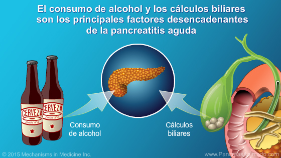 Manejo y tratamiento de la pancreatitis aguda - Slide Show - 5