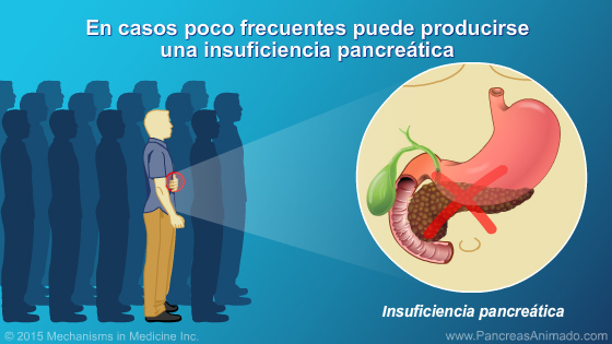 Manejo y tratamiento de la pancreatitis aguda - Slide Show - 17