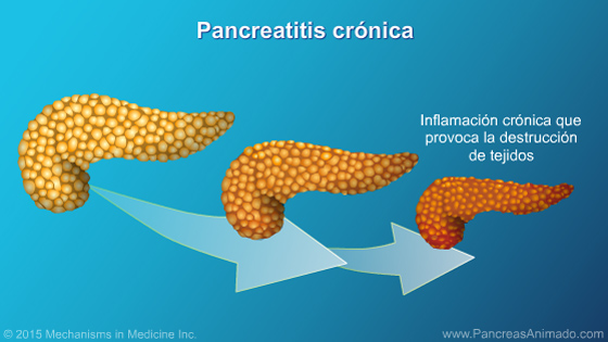 Manejo y tratamiento de la pancreatitis crónica - Slide Show - 4