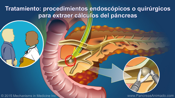 Manejo y tratamiento de la pancreatitis crónica - Slide Show - 15