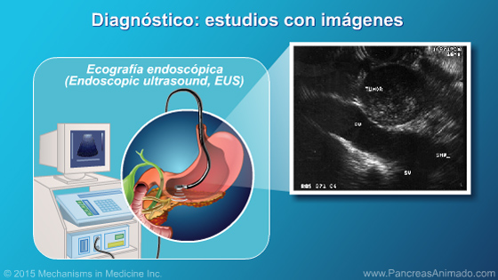 Fisiopatología, diagnóstico y estadificación - Slide Show - 11